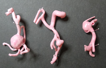 動脈瘤局所のシリコンモデル3例 画像ご提供先：自治医科大学 脳神経外科様