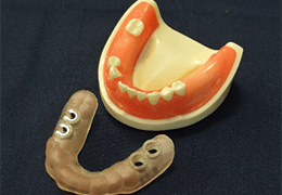 サージカルステントと歯科模型
